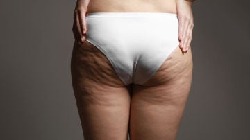Celulitis Celulitis