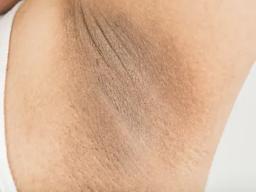 Axilas oscuras Axilas oscuras