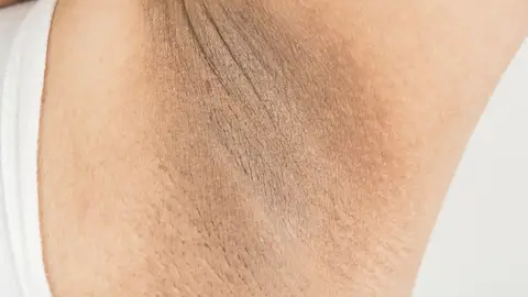 Axilas oscuras Axilas oscuras