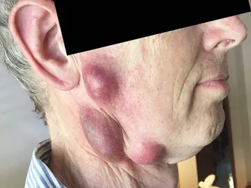 Los bultos en el cuello del hombre Los bultos en el cuello del hombre