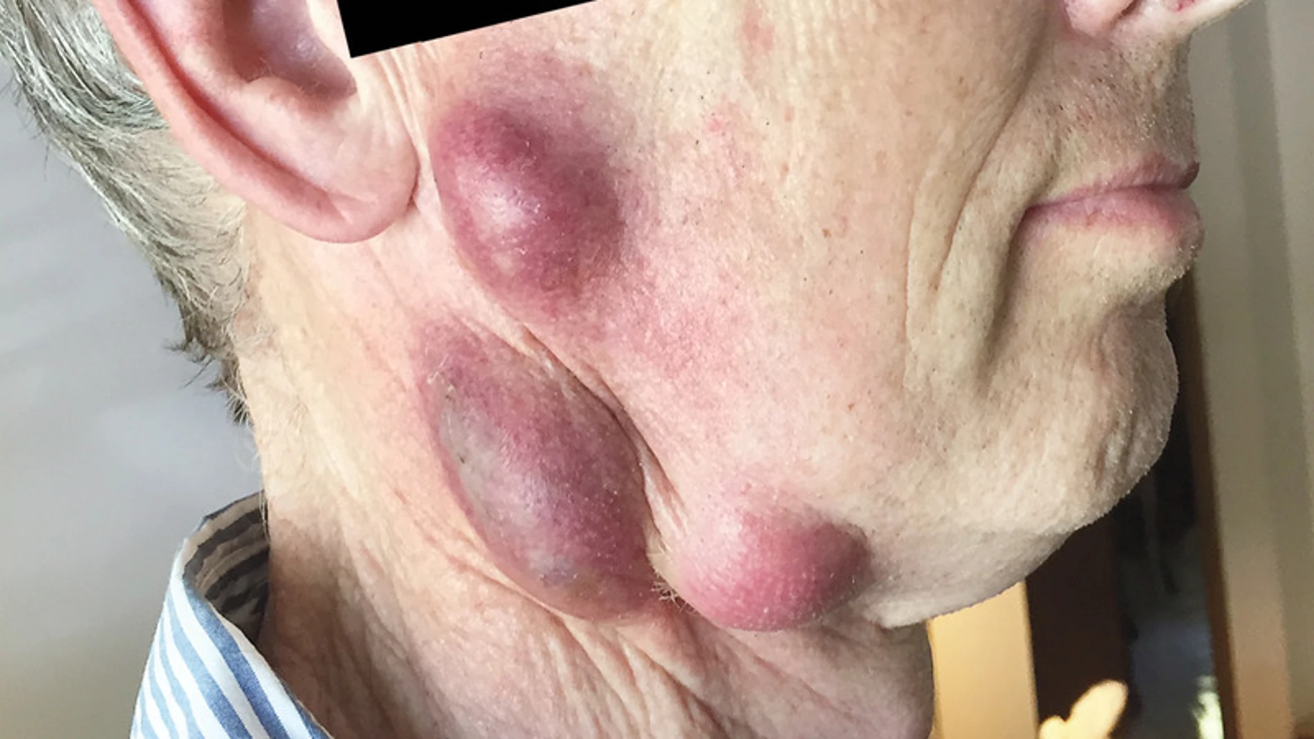 Los bultos en el cuello del hombre Los bultos en el cuello del hombre