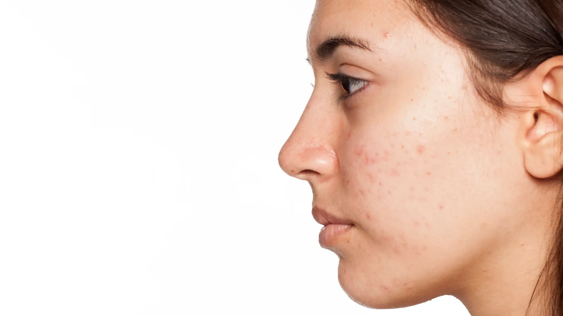 Terraplén Negociar continuar Cómo evitar que el acné te deje cicatrices en la piel