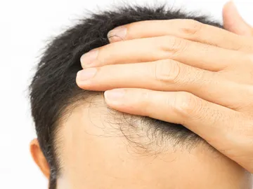 Caída de pelo Caída de pelo