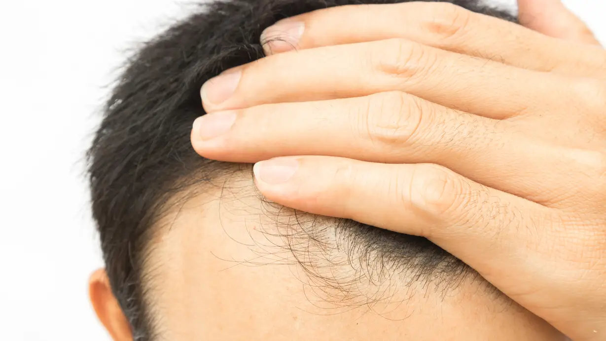 Caída de pelo Caída de pelo