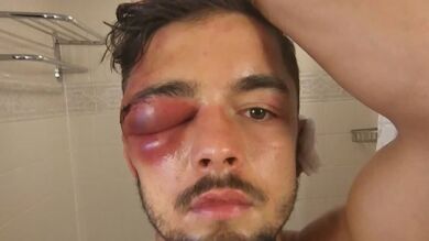 La terrible lesión en el ojo del boxeador Anthony Yigit que le obligó a retirarse de un combate