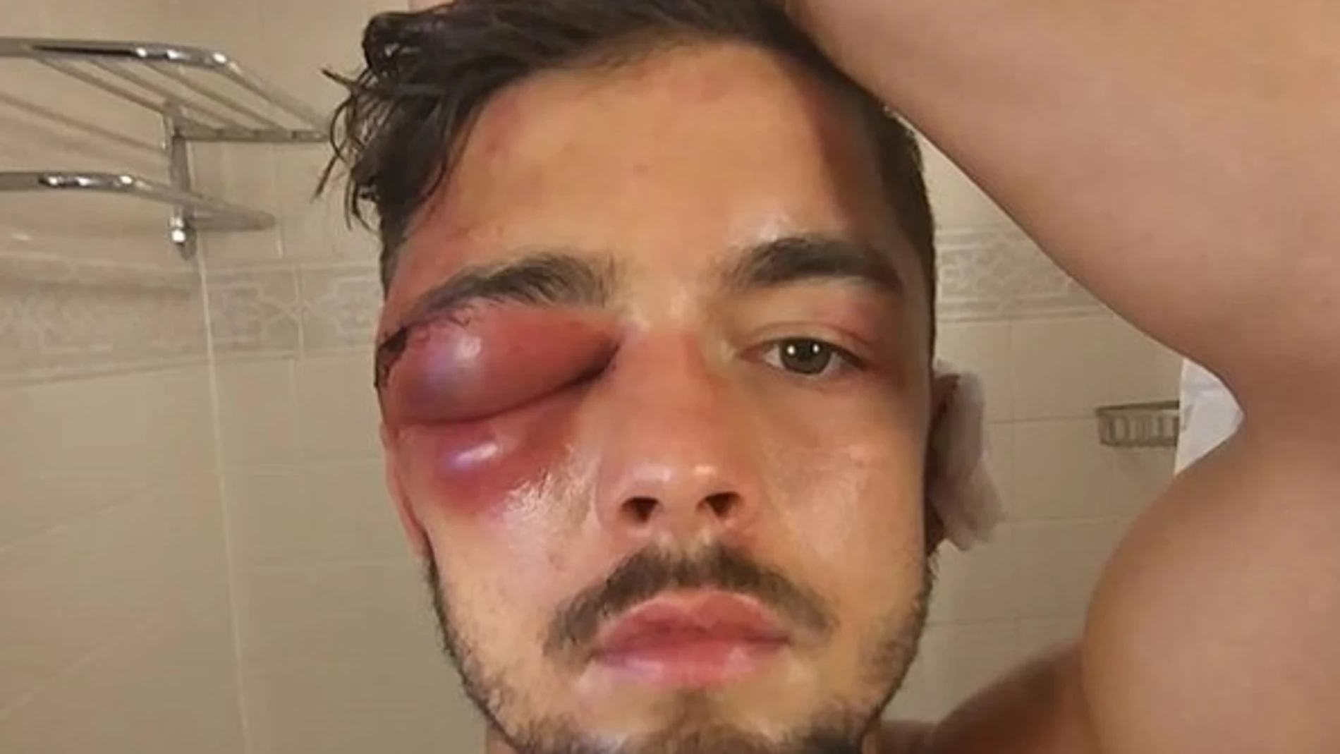 La lesión que obliga a retirarse del mundial superligero a Anthony Yigit La lesión que obliga a retirarse del mundial superligero a Anthony Yigit