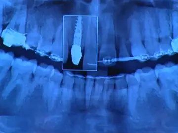 Indemnización de 2,5 millones de euros para una paciente alérgica al metal a la que se le implantó unas prótesis de cobalto Indemnización de 2,5 millones de euros para una paciente alérgica al metal a la que se le implantó unas prótesis de cobalto