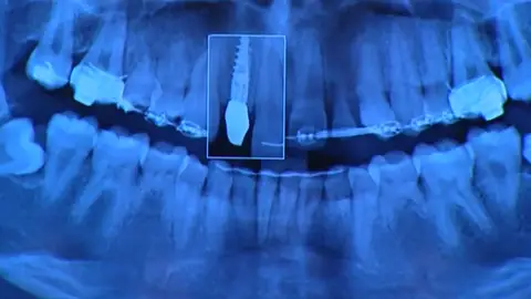 Indemnización de 2,5 millones de euros para una paciente alérgica al metal a la que se le implantó unas prótesis de cobalto Indemnización de 2,5 millones de euros para una paciente alérgica al metal a la que se le implantó unas prótesis de cobalto