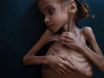 La pequeña Amal Hussain La pequeña Amal Hussain