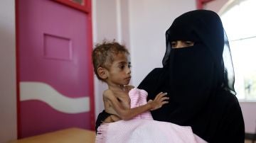 Un niño con malnutrición en el hospital de Saná