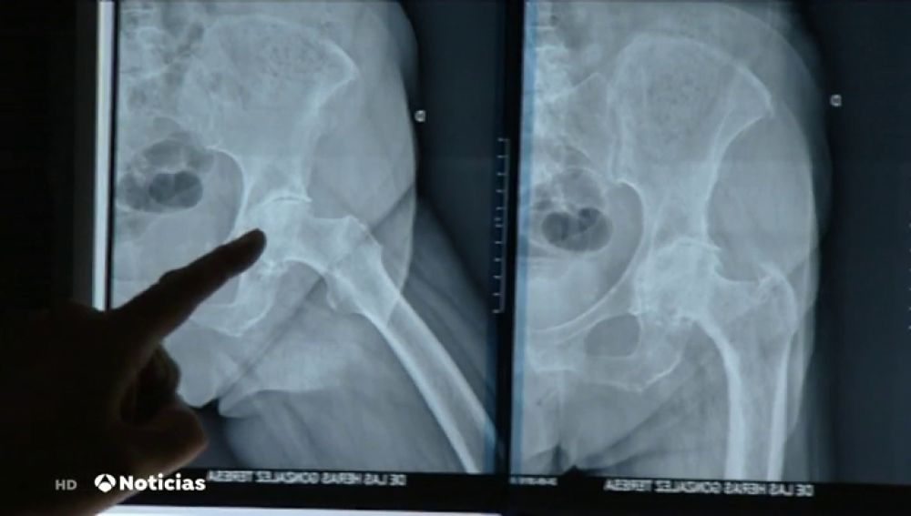 Sanidad y sociedades científicas califican de "anecdótica" la incidencia de implantes defectuosos