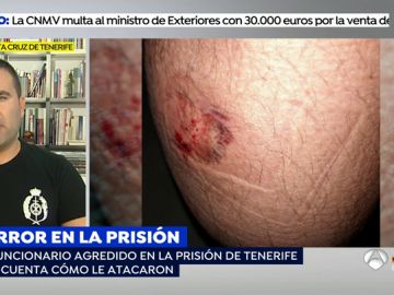 Víctima de la agresión de un preso: "Me mordió en el gemelo ejerciendo cada vez más fuerza y era imposible separarle de mi pierna"