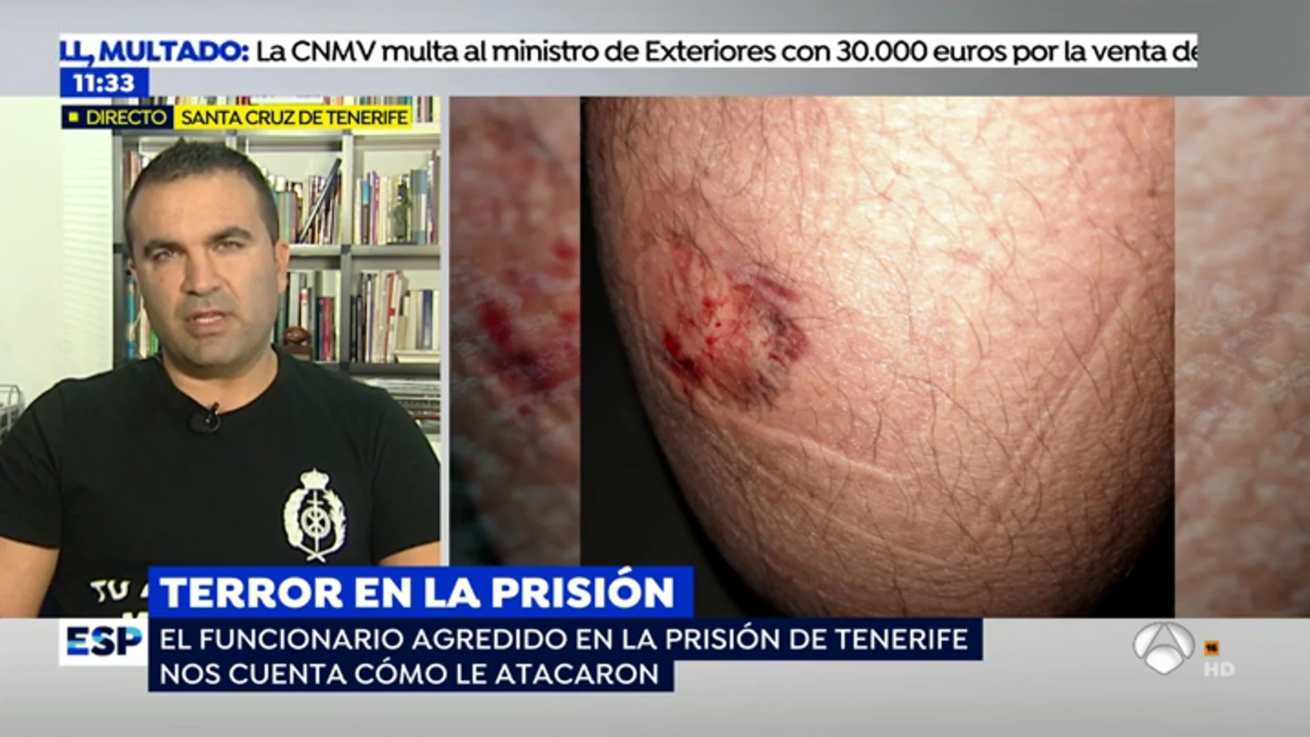 Víctima de la agresión de un preso: "Me mordió en el gemelo ejerciendo cada vez más fuerza y era imposible separarle de mi pierna"