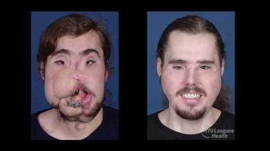 Sorprendente reconstrucción facial: el trasplante de cara que ha devuelto las ganas de vivir a un joven de 26 años