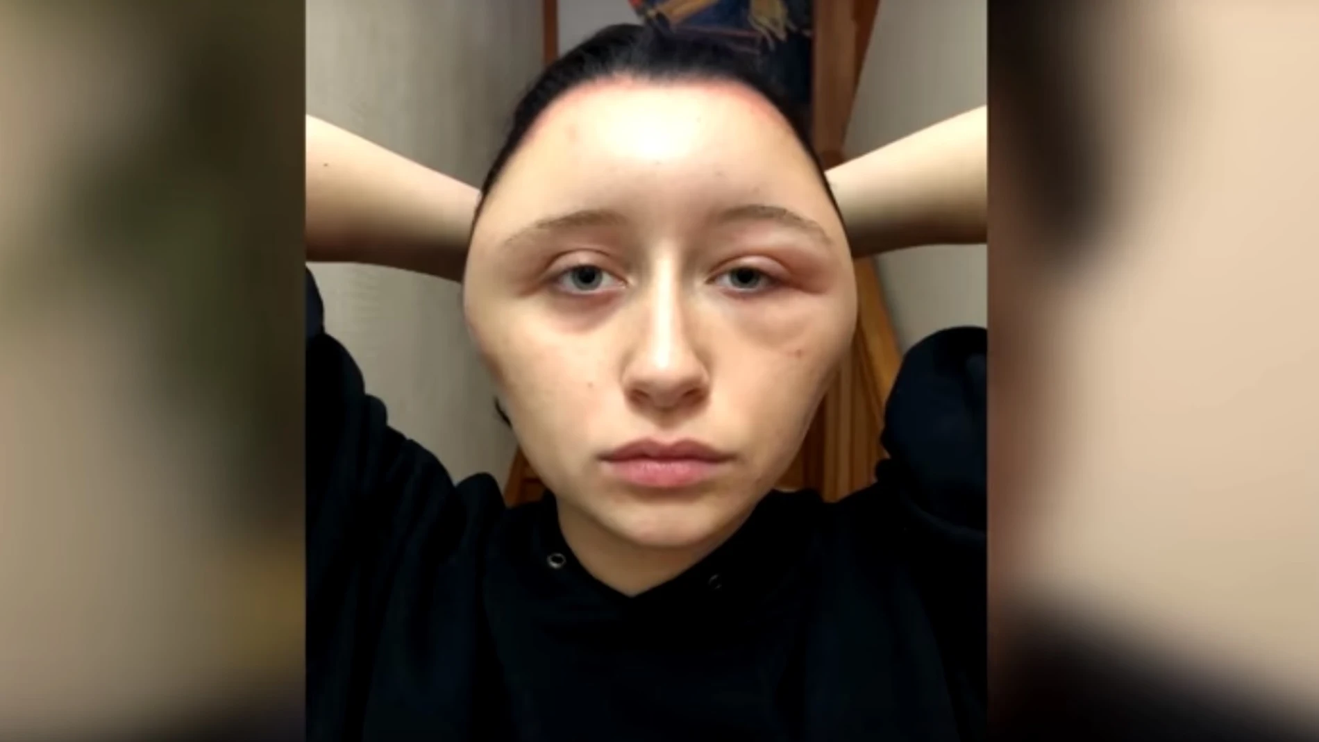 La joven tras sufrir la reacción alérgica La joven tras sufrir la reacción alérgica