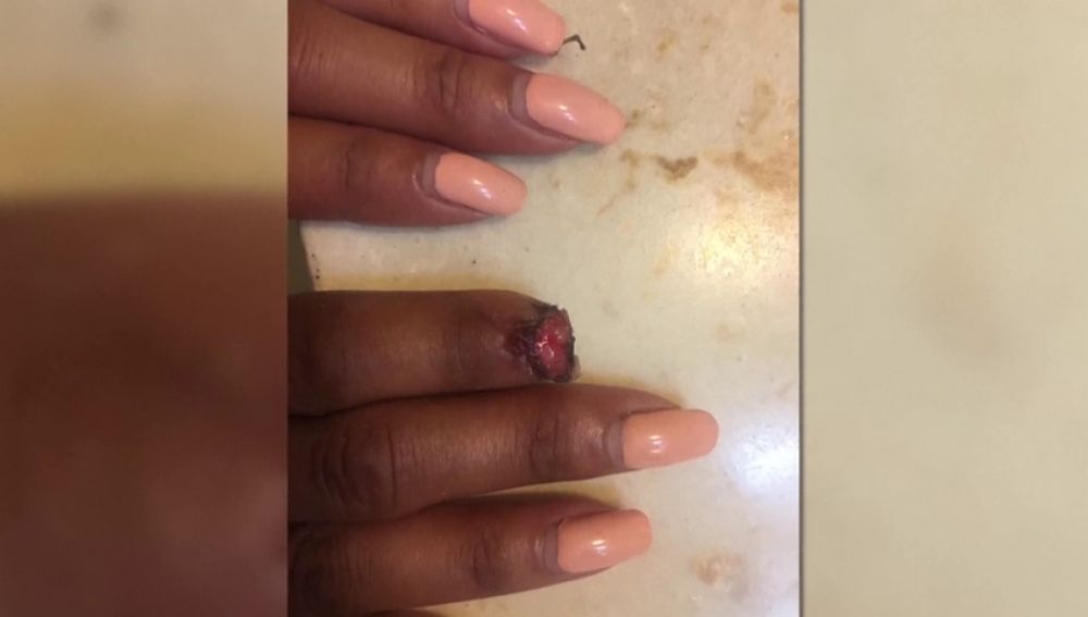 Un puma arrancó parte de su dedo y gracias a la terapia 'PRP' ha vuelto a crecer su yema(, la recuperación ha sido tal que incluso los médicos están impresionados)