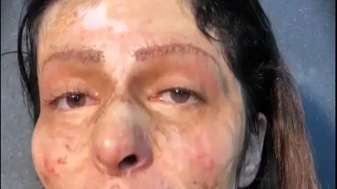 mujer quemada mujer quemada