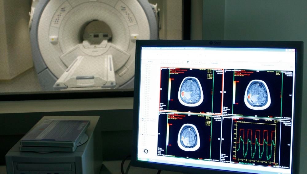 Imagen de un tumor cerebral 