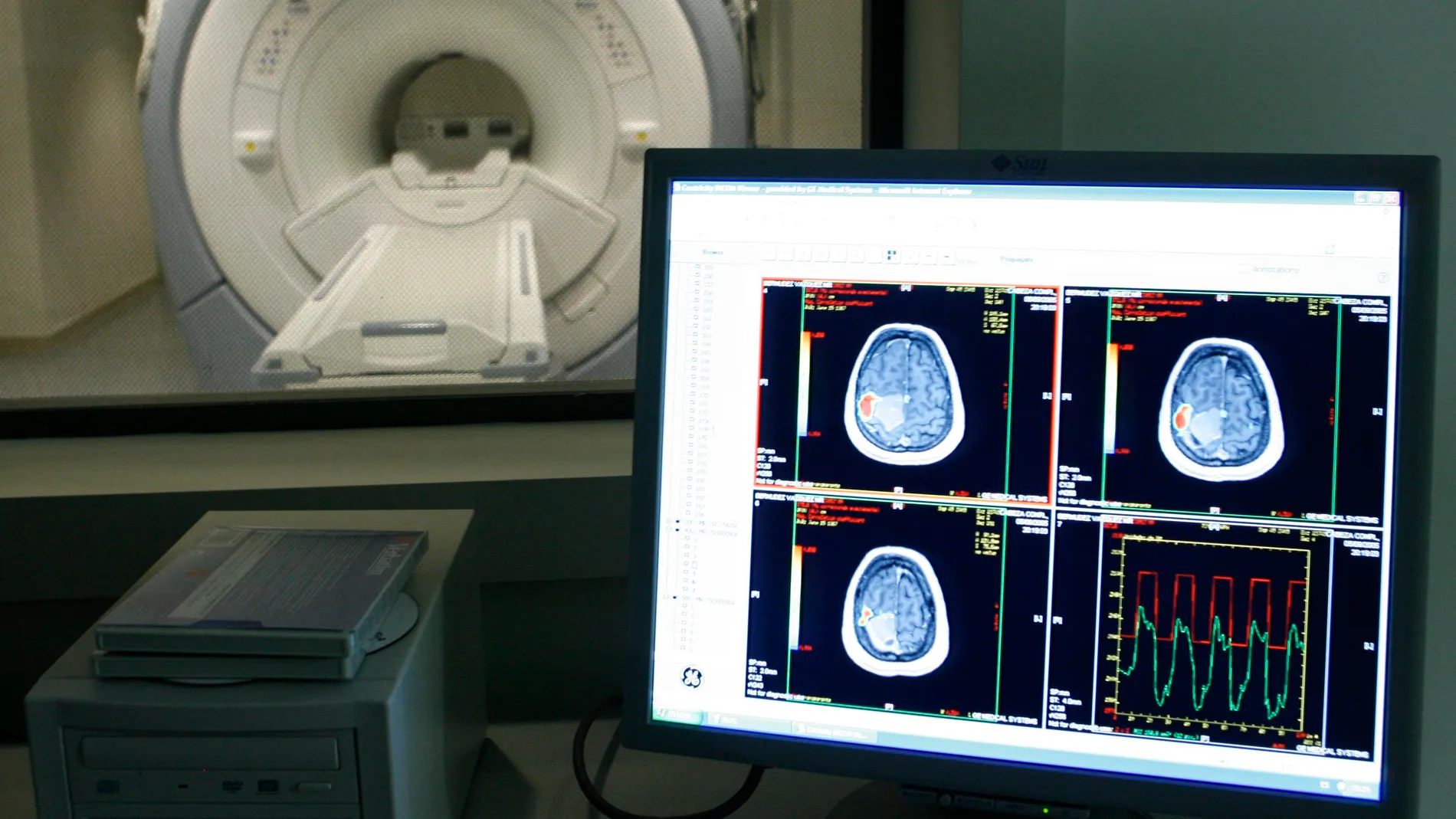 Imagen de un tumor cerebral Imagen de un tumor cerebral