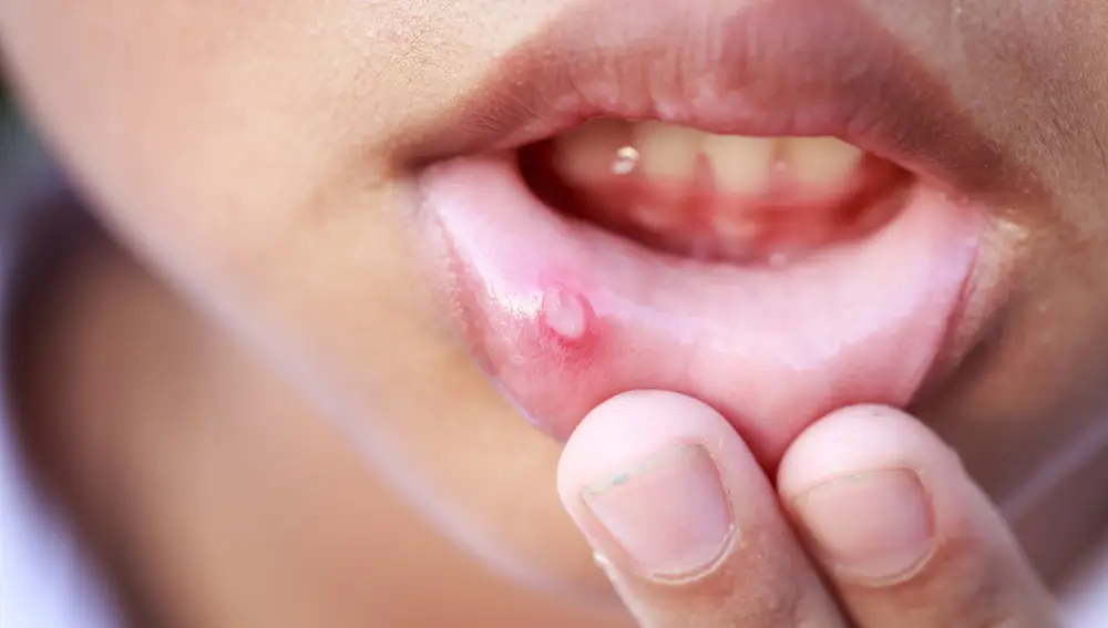 Úlceras en la boca