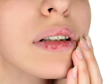 Labios agrietados Labios agrietados