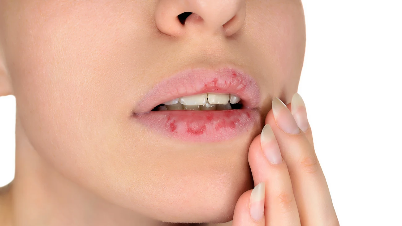 Labios agrietados Labios agrietados