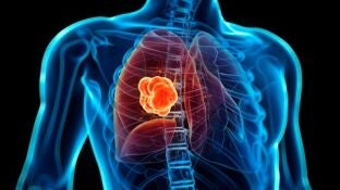 C&aacute;ncer de pulm&oacute;n