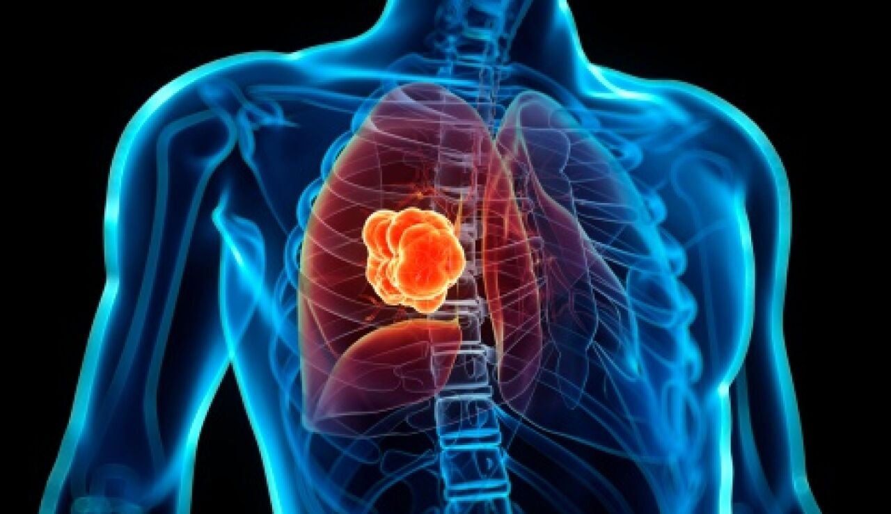 C&aacute;ncer de pulm&oacute;n
