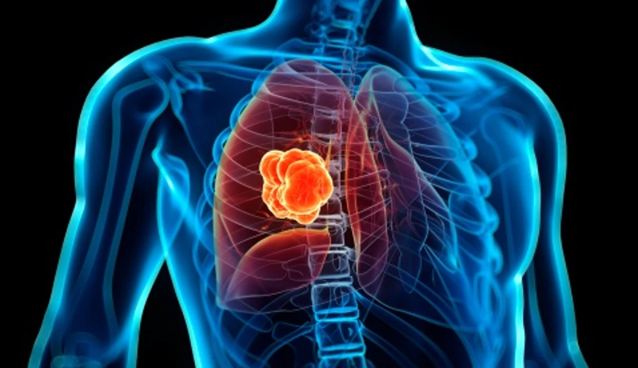 Cáncer de pulmón
