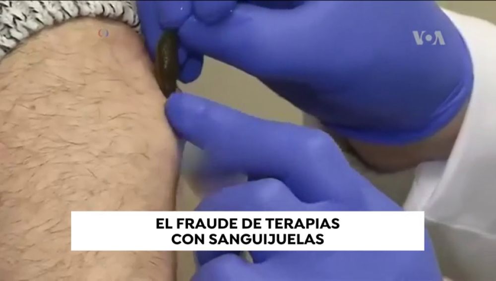 Médicos españoles denuncian el fraude de terapias con sanguelas