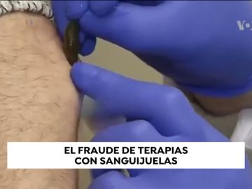 Médicos españoles denuncian el fraude de terapias con sanguelas
