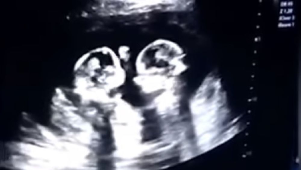 La pelea de dos gemelas en el vientre de su madre