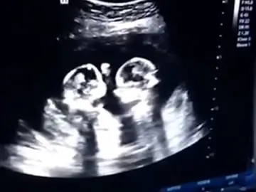 La pelea de dos gemelas en el vientre de su madre La pelea de dos gemelas en el vientre de su madre