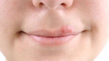 Remedios naturales para herpes en la boca