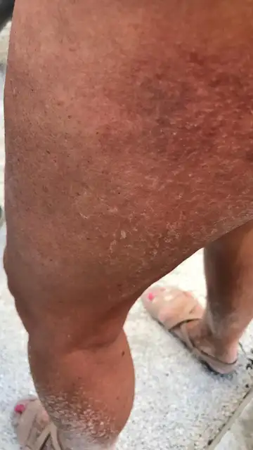 Herida en el muslo a causa del tobogán Herida en el muslo a causa del tobogán