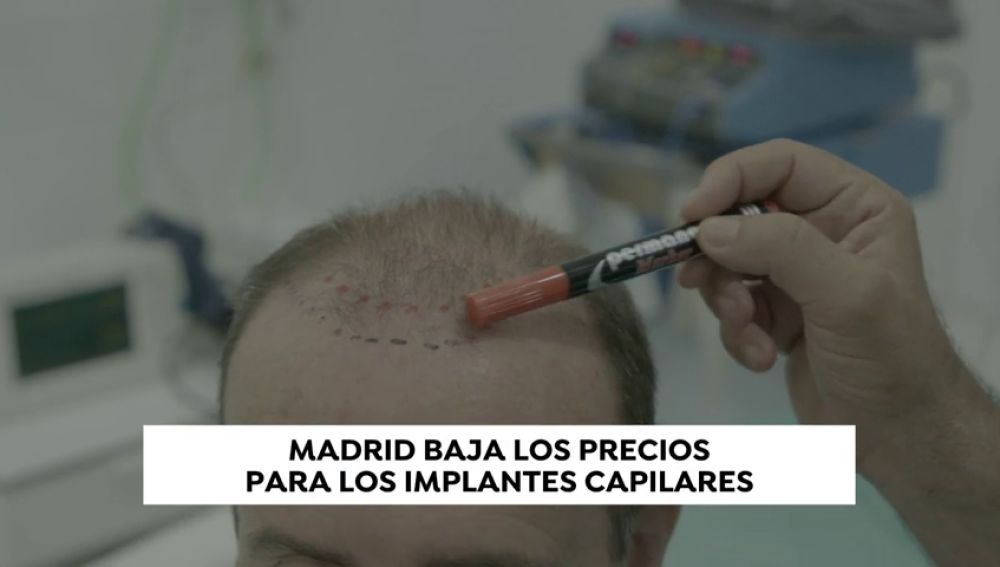 ¿La nueva Estambul? Madrid baja los precios para los implantes capilares