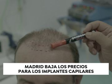 ¿La nueva Estambul? Madrid baja los precios para los implantes capilares ¿La nueva Estambul? Madrid baja los precios para los implantes capilares