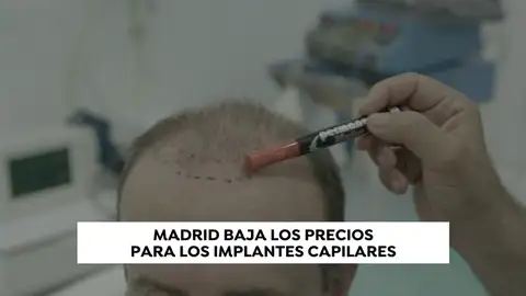 ¿La nueva Estambul? Madrid baja los precios para los implantes capilares ¿La nueva Estambul? Madrid baja los precios para los implantes capilares