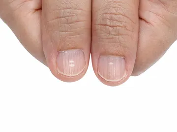 Uñas con falta de calcio Uñas con falta de calcio