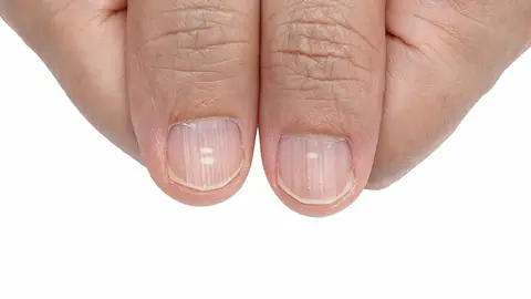 Uñas con falta de calcio Nova Life