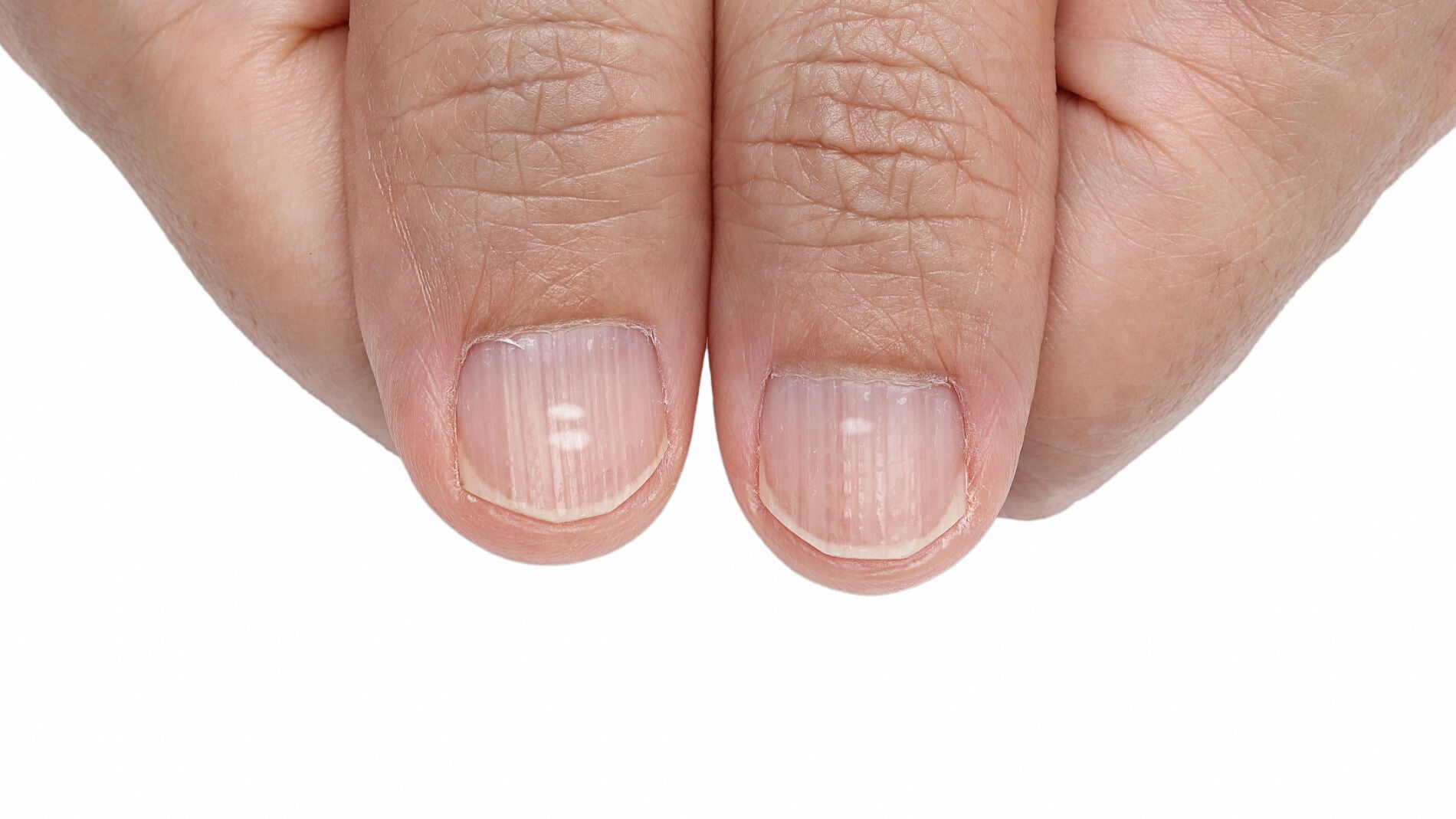 U&ntilde;as con falta de calcio