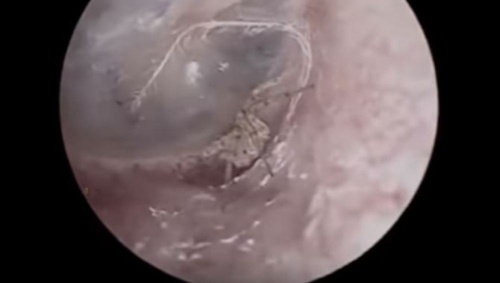 La araña viviendo dentro del oído del paciente