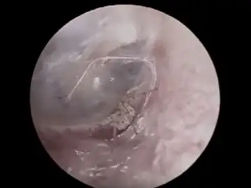 La araña viviendo dentro del oído del paciente La araña viviendo dentro del oído del paciente