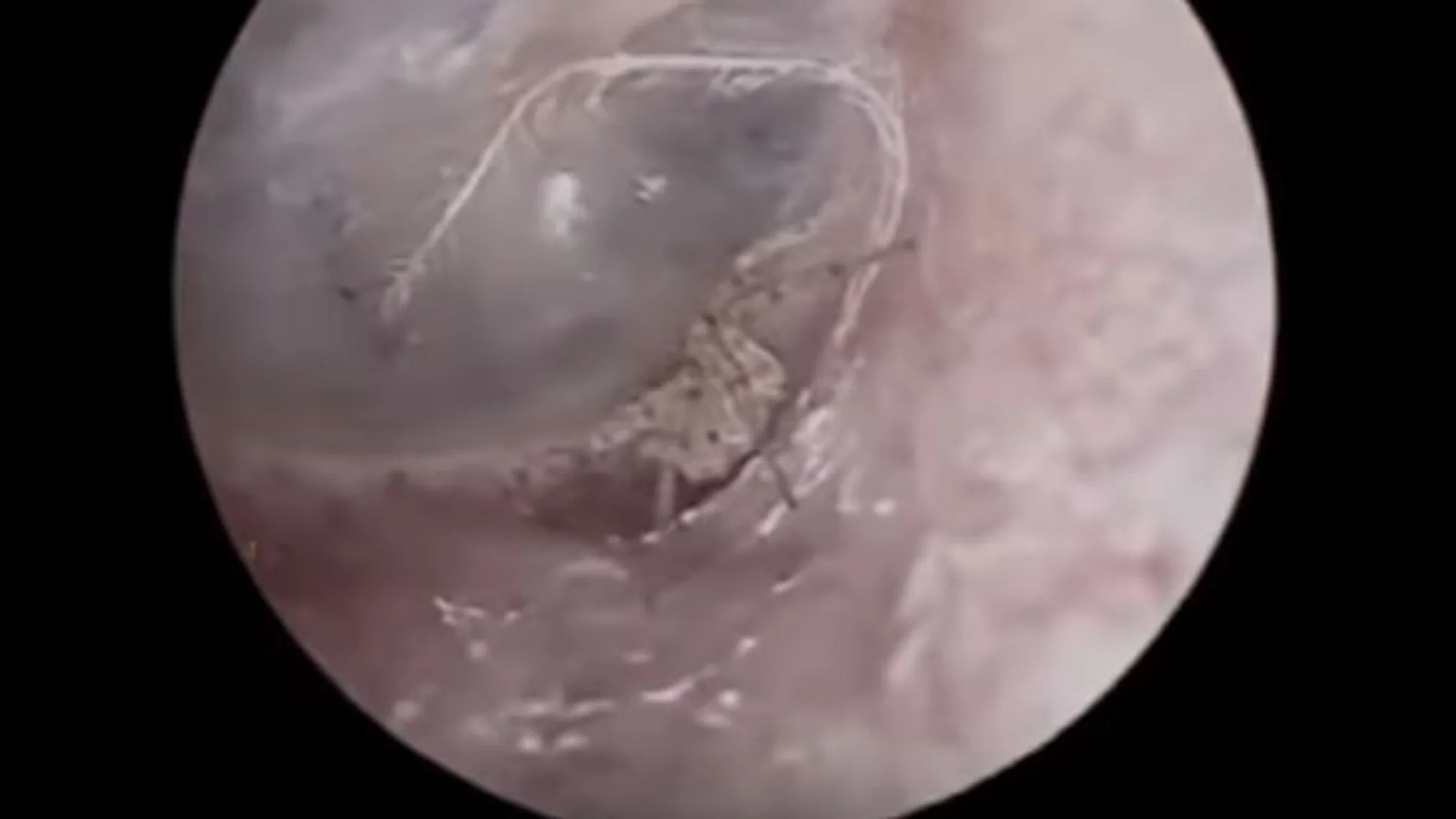 La araña viviendo dentro del oído del paciente La araña viviendo dentro del oído del paciente