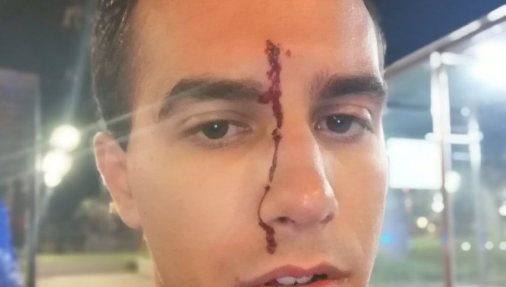 El periodista Xavier Martínez tras sufrir una agresión homófoba