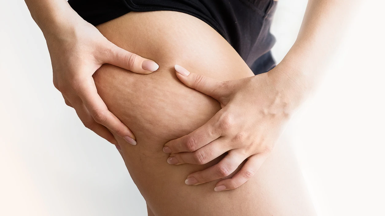 Celulitis Celulitis