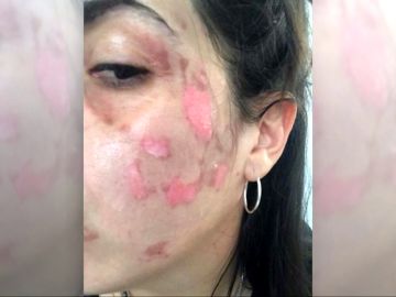 Dos mujeres sufren quemaduras de segundo grado al explotarles un robot de cocina