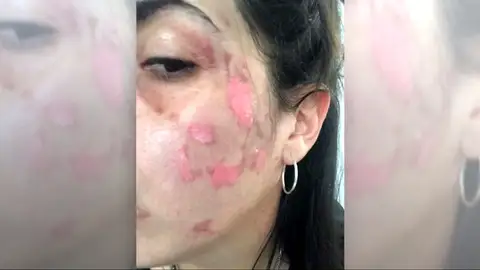 Dos mujeres sufren quemaduras de segundo grado al explotarles un robot de cocina Dos mujeres sufren quemaduras de segundo grado al explotarles un robot de cocina