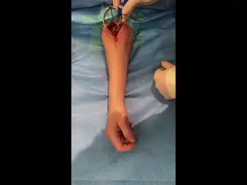 13 tetrapléjicos recuperan la movilidad gracias a un trasplante de nervios en Australia 13 tetrapléjicos recuperan la movilidad gracias a un trasplante de nervios en Australia