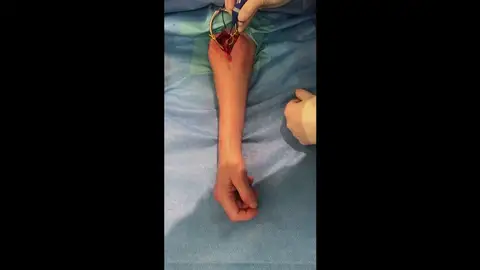 13 tetrapléjicos recuperan la movilidad gracias a un trasplante de nervios en Australia 13 tetrapléjicos recuperan la movilidad gracias a un trasplante de nervios en Australia